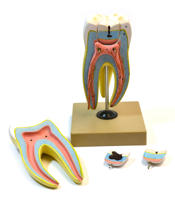 Eisco Labs Human Upper Triple Root Molar with interchangeable cavities - 6 parts