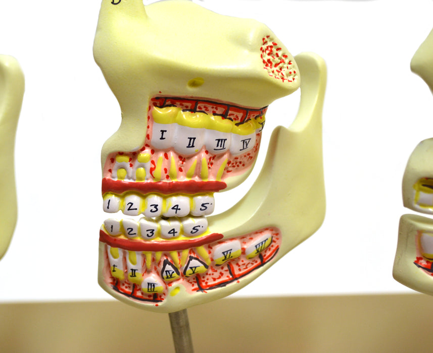 Eisco Labs Dentition Model - 4 Stages; 8 Pieces