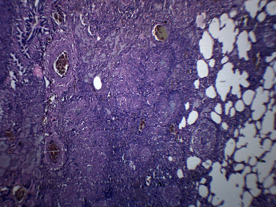 Tuberculosis, Human Lung Section - Prepared Microscope Slide - 75x25mm
