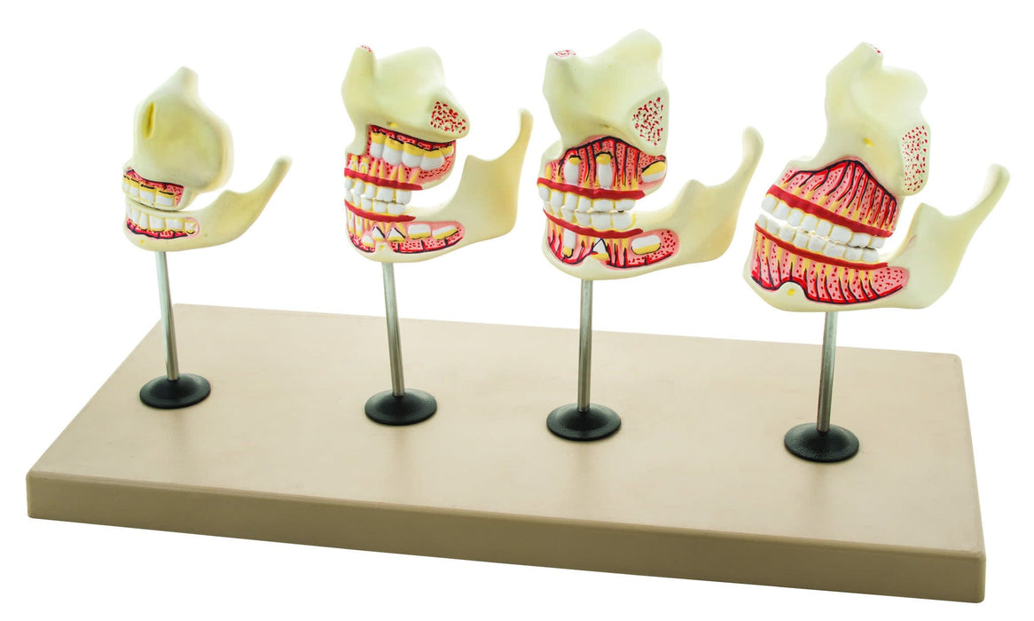 Eisco Labs Dentition Model - 4 Stages; 8 Pieces