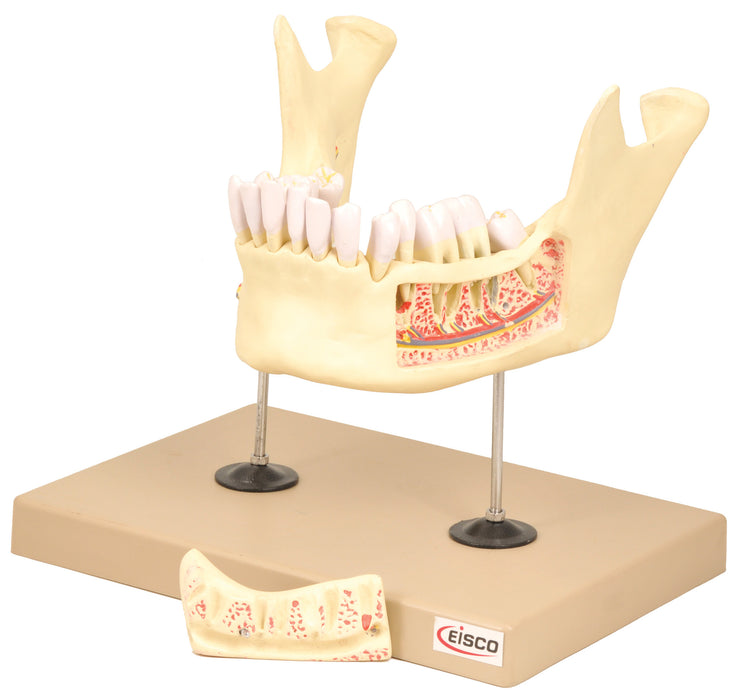 Model Dental Disease - 21 Parts