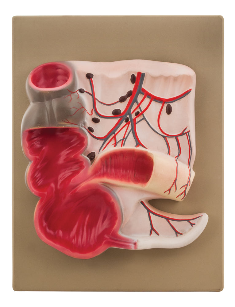 Apendix Ando Loop Vermiform Appendix