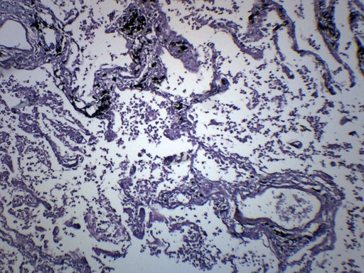 Pneumonia in Human Lungs - Prepared Microscope Slide - 75x25mm