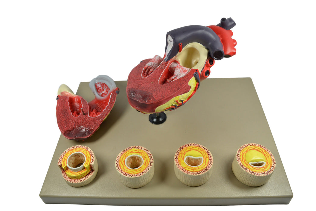 Eisco Labs Model of Human Heart Conditions Pathology; Larger than life size (10"); Artery Cross sections 2.5" in diameter