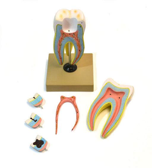 Eisco Labs Human Upper Triple Root Molar with interchangeable cavities - 6 parts
