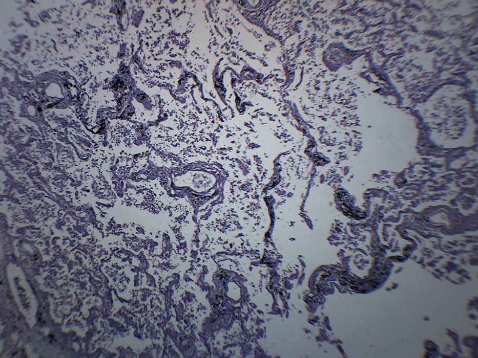 Pneumonia in Human Lungs - Prepared Microscope Slide - 75x25mm